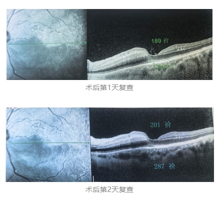 視網(wǎng)膜中央動(dòng)脈阻塞